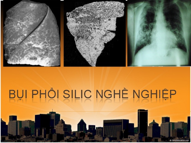 Tìm Hiểu Về Bệnh Bụi Phổi Silic(CAM)