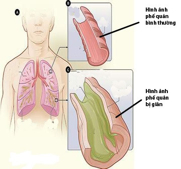 Bệnh Giãn Phế Quản Là Gì?