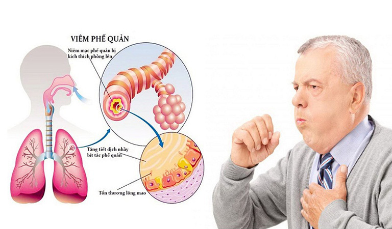 Biến Chứng Nguy Hiểm Từ Viêm Phế Quản Cấp(CAM)