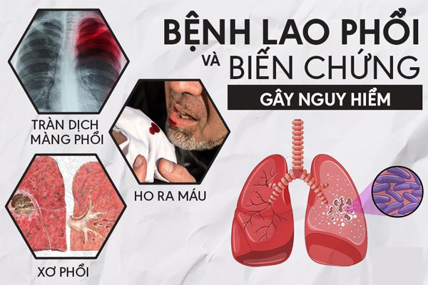 Biến Chứng Nguy Hiểm Của Bệnh Lao Có Thể Bạn Chưa Biết(CAM)