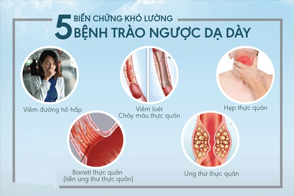 Giải Đáp Các Biến Chứng Của Bệnh Trào Ngược Dạ Dày Thực Quản Gây Ra