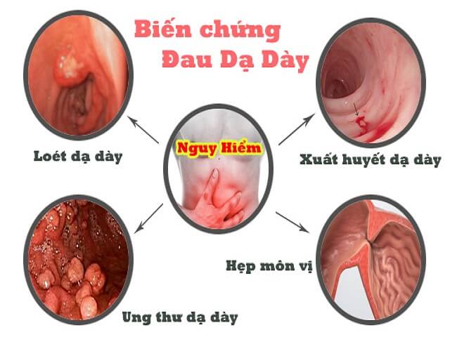 Biến Chứng Của Viêm Loét Dạ Dày Tá Tràng