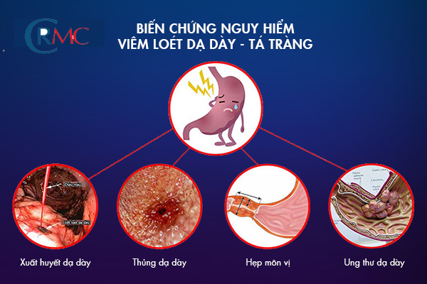 Viêm Loét Dạ Dày Tá Tràng Nguy Hiểm Như Thế Nào?