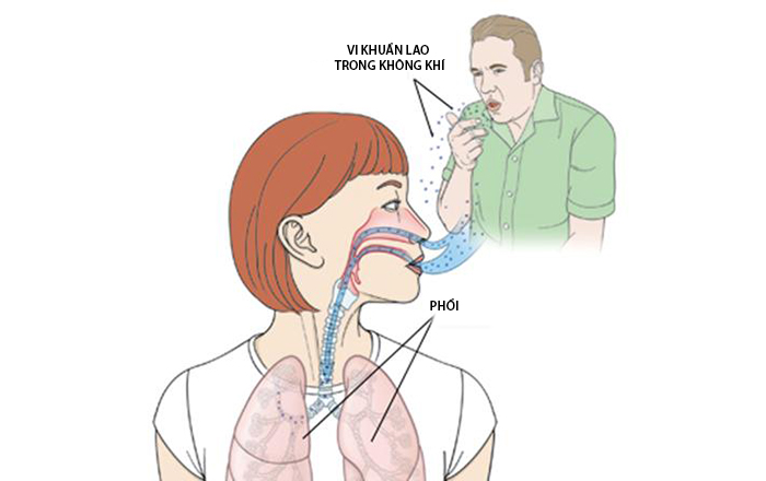 Nguyên Nhân Của Bệnh Lao Phổi(CAM)