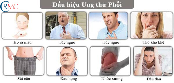 Triệu Chứng Nhận Biết Sớm Ung Thư Phổi(CAM)