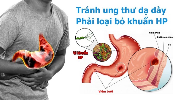 Dấu Hiệu Cho Biết Bạn Đã Bị Nhiễm Vi Khuẩn Hp