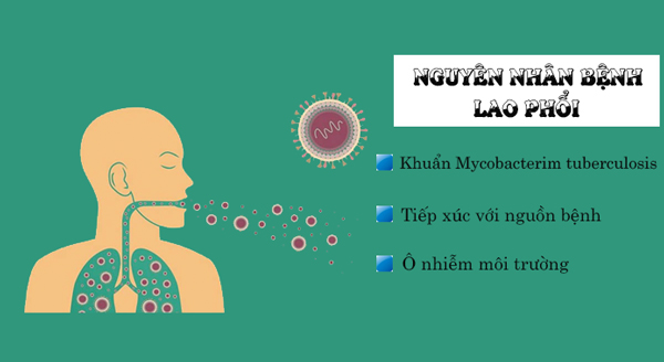 Tổng Quan Về Bệnh Lao Phổi(CAM)