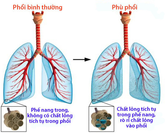 Bệnh Phù Phổi Và Những Thông Tin Cần Biết(CAM)