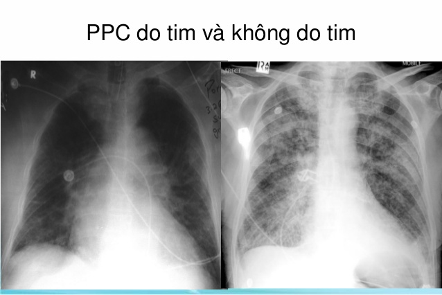 Những Thông Tin Cần Biết Về Bệnh Phù Phổi Do Tim(CAM)