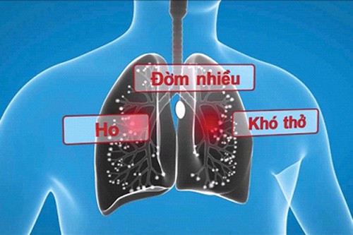 Triệu Chứng Nhận Biết Bệnh Giãn Phế Quản