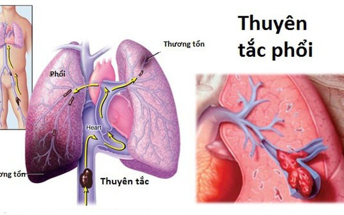 Bạn Biết Gì Về Thuyên Tắc Phổi(CAM)