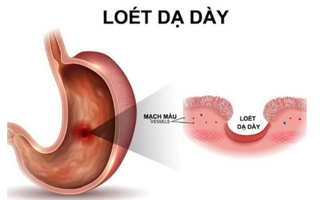 Những Biến Chứng Khó Lường Của Viêm Loét Dạ Dày Tá Tràng