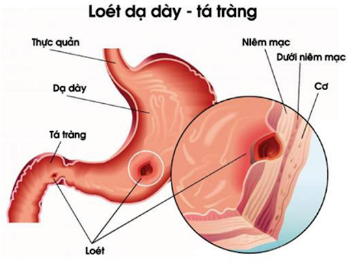 Chữa Viêm Loét Dạ Dày Tá Tràng Hiệu Qủa Bằng Cách Nào?
