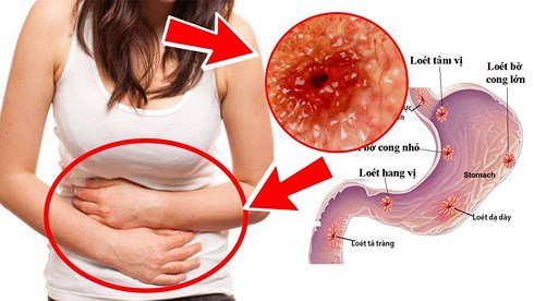 Chẩn Đoán Viêm Loét Dạ Dày Tá Tràng Bằng Cách Nào?