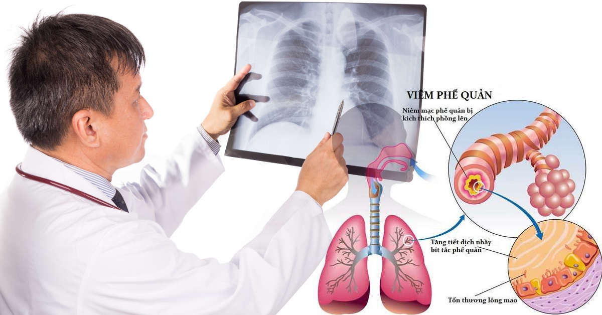 Các Bệnh Lý Về Phổi Thường Gặp