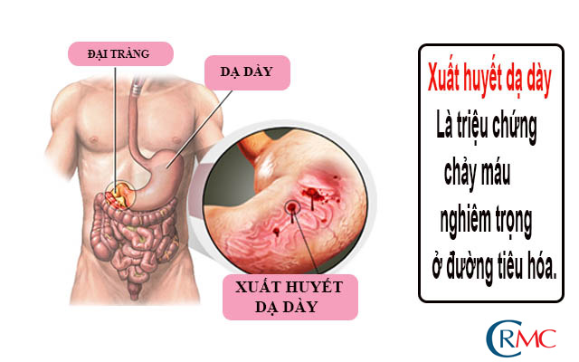 Xét Nghiệm Xuất Huyết Tiêu Hóa Chính Xác
