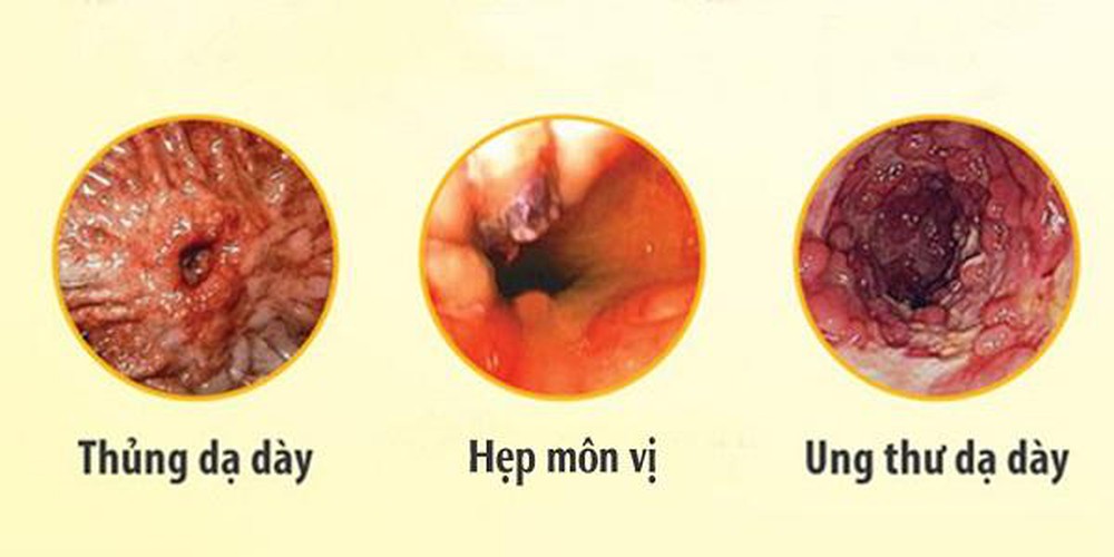 Xuất Huyết Tiêu Hóa Nguy Hiểm Như Thế Nào?
