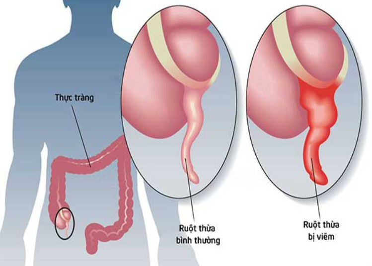Viêm ruột thừa cấp : triệu chứng nhận biết nguyên nhân và cách điều trị.